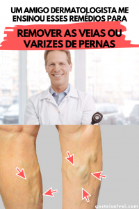 Read more about the article Um amigo dermatologista me ensinou esses remédios para remover as veias ou varizes de pernas