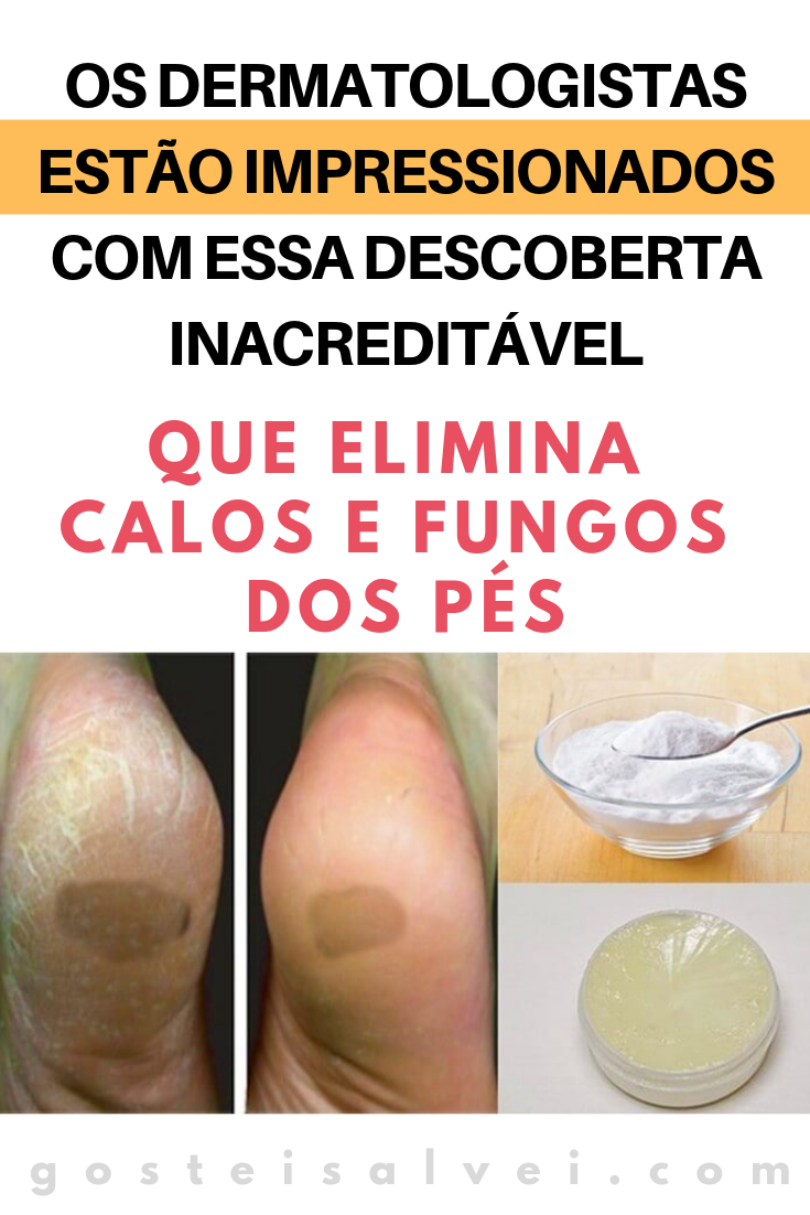 You are currently viewing Os Dermatologistas Estão Impressionados Com Essa Descoberta Inacreditável Que Elimina Calos e Fungos Dos Pés
