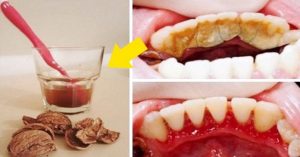 Read more about the article A melhor receita caseira para eliminar a placa bacteriana e o tártaro facilmente!