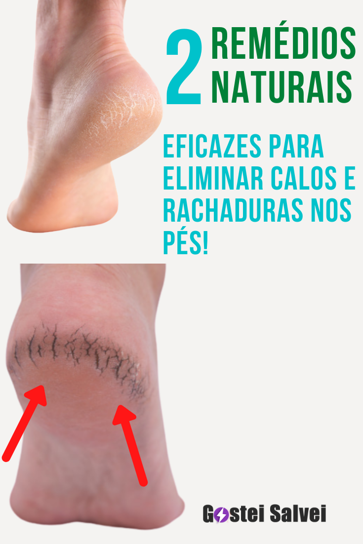 You are currently viewing 2 Remédios naturais eficazes para eliminar calos e rachaduras nos pés!
