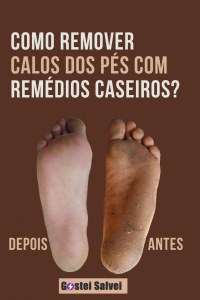 Read more about the article Como remover calos dos pés com truques caseiros?