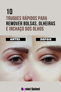 Read more about the article 10 Truques rápidos para remover bolsas, olheiras e inchaço dos olhos